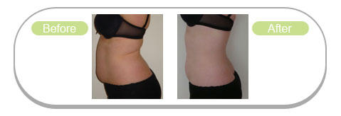 Lipofirm-before-after-2