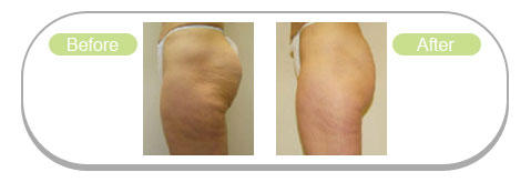 Lipofirm-before-after-3
