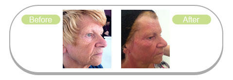 Lipofirm-before-after-4