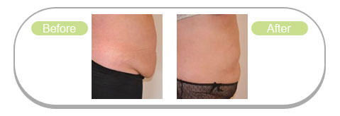 Lipofirm-before-after-5